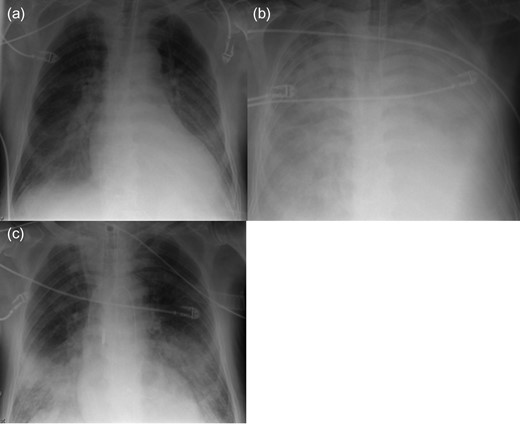 Radiography of Patient 1. (a) After ECLS implantation. (b) Before Impella implantation. (c) Two days after Impella implantation.