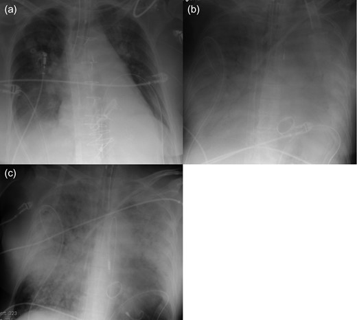 Radiography of Patient 2. (a) After open heart surgery. (b) Before Impella implantation. (c) Two days after Impella implantation.