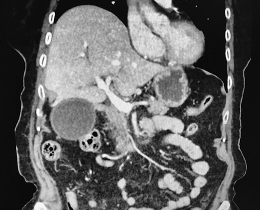 CT abdomen with contrast (coronal view).