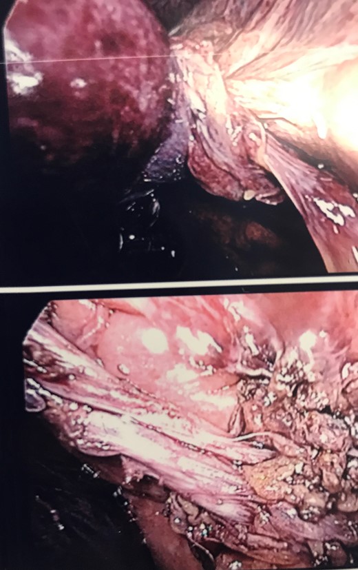 Intraoperative imaging showing gallbladder volvulus and detorsion of the cystic duct and artery.
