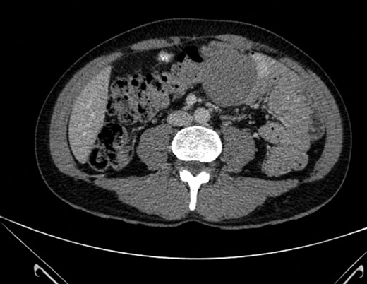 Well-circumscribed mass measuring 5.5 × 5.6 cm2 projecting from the mesenteric fat and lying adjacent to the transverse colon with no identifiable cleavage plane between them. No pathological lymphadenopathy identified.
