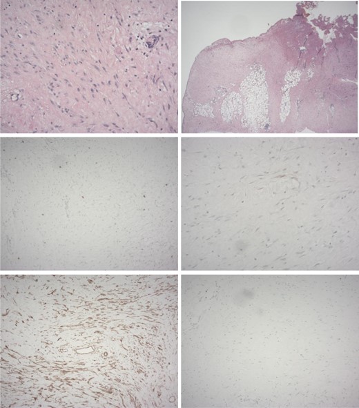 Histology of resected specimen. From top to bottom and left to right. (A) Haematoxylin and eosin staining showing spindle cells (B) spindle cells can be seen infiltrating adipose tissue. (C) Staining negative for CD117 and (D) DOG-1. (E) staining strongly positive for beta catenin. (F) Weak Ki67 staining. Supporting the diagnosis of Desmoid tumour.