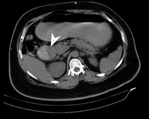 CT (transverse) image showing first and second part of duodenum filled with a mass lesion.