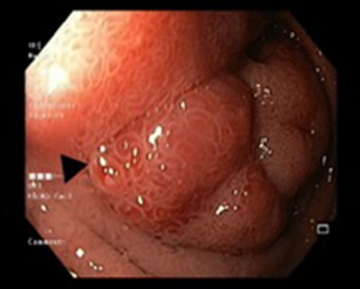 Endoscopic view of the duodenal mass being biopsied.