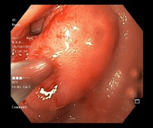 Endoscopic view of a submucosal mass in the second part of the duodenum.