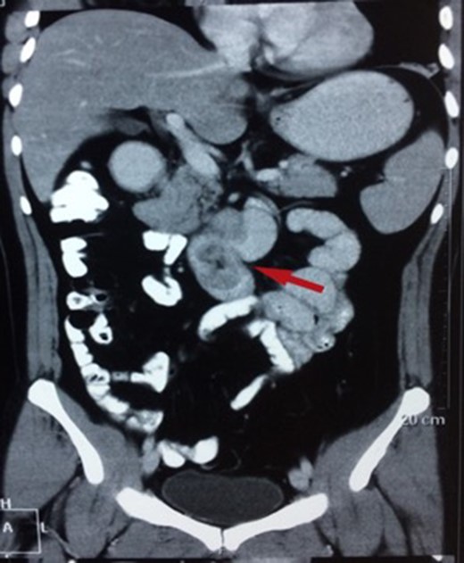 CT showing a polypoid lesion extending from the first part of the duodenum and projecting into the lumen of the second and third part.