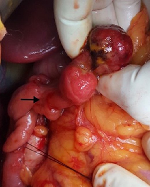 Intra-operative photograph showing the polypoid lesion in the second part of duodenum after a duodenotomy.