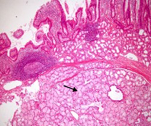Microscopic appearance of Brunner’s gland hyperplasia. Arrow pointing at Brunner’s glands in the submucosa (stained by H & E).