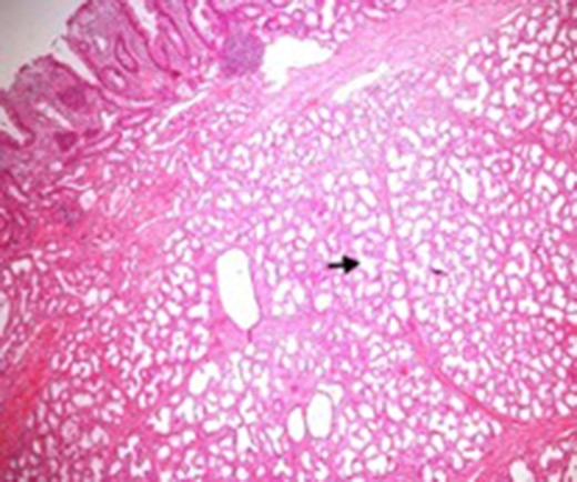 Microscopic appearance of Brunner’s gland hyperplasia. Arrow pointing at Brunner’s glands in the submucosa (stained by H & E).