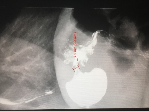 An X-ray of the stomach with gastric banding and a stenosis. Barium has been administered.
