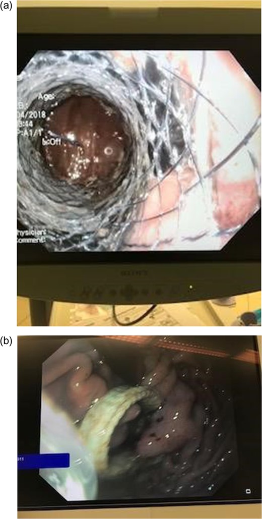 The figure illustrates the inserted stent. (a) The gastric stent in position in the stenosis and (b) the available gastric band due to tissue necrosis.
