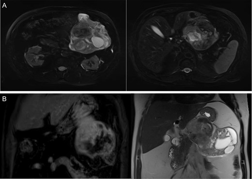 (A) CT abdomen demonstrates large heterogenous mass. (B) MRI coronal images display a heterogeneous mass on T1 (left) and T2 signal (right) arising from the submucosa with components restricting diffusion.