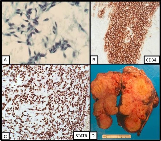 (A) On fine needle aspiration cytology, bland spindle cells are present. (B) On cell block, the lesional cells stains strongly with CD34 immunostain. (C) On repeat fine needle aspiration cytology, STAT6 displays strong nuclear staining. (D) Gross image of the resection specimen revealing a tan solid and cystic lobulated submucosal mass.
