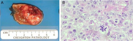 (A) Liver metastastectomy demonstrating ‘fish fleshy’ consistency of metastatic sarcoma. (B) Metastasic lesion demonstrating dense solid sheets of spindled to round high-grade pleomorphic nuclei with large, prominent nucleoli, numerous mitotic figures (including atypical, bizarre forms) and large areas of geographic necrosis.