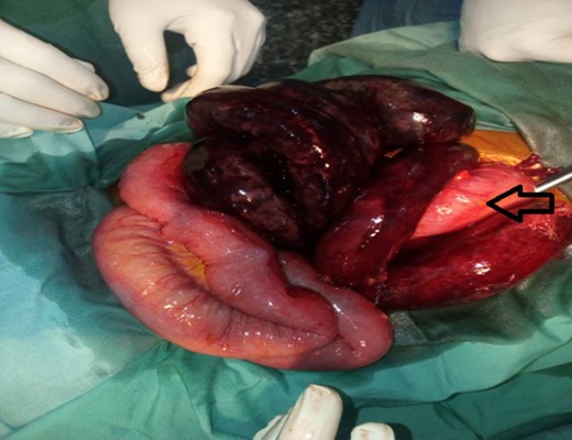 The gangrenous small bowel and the arrow indicates the viable sigmoid.