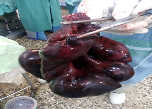 The resected small bowel.