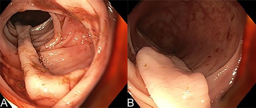Colonoscopy of the sigmoid colon showing (A) and (B) the long stalk of the prolapsing mucosal polyp in the sigmoid colon.