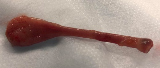 Resected 45 × 12 × 5 mm3 prolapsing mucosal polyp.