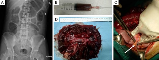 (A) Abdominal X-ray showed dilated small bowel without free air. (B) Ultrasound-guided paracentesis revealed unclotted blood. (C) One hundred-centimeter segment of necrotic jejunum secondary to adhesion band (arrow) was found at the time of exploratory laparotomy. (D) Resected specimen showed diffuse dark discoloration of the ischemic segment of mid-small intestine.