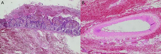 (A) Sections of small bowel showed transmural hemorrhagic necrosis with acute inflammatory exudates and congestion. (B) Mesenteric arteries supplying the segment of excised small bowel contained no thrombi.