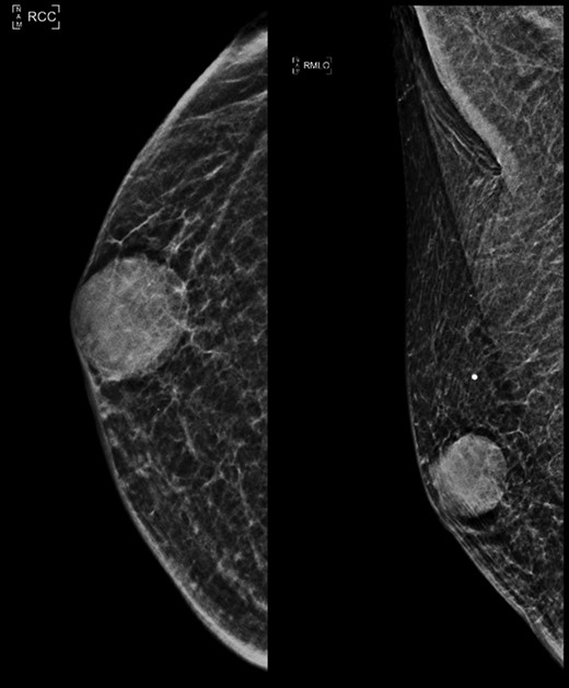 Right mammogram craniocaudal (CC) and medial oblique (MLO) view.