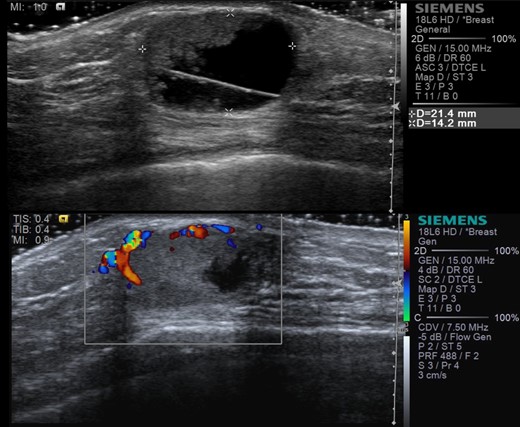 Ultrasound images showing right retroareolar complex cyst with indeterminate solid component (a) and internal vascularity (b).