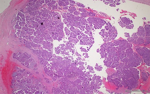 A thick fibrous wall surrounding a cystic space with a complex and arborizing papillary network within (magnification x2).