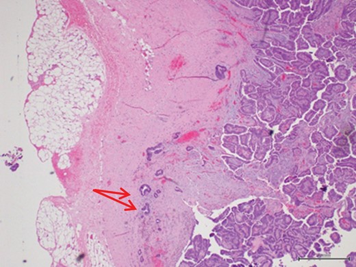 Scattered tubules (arrow) within the stroma with no extension beyond the fibrous wall. These scattered tubules measure 3 mm (magnification x4).
