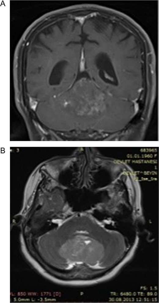 (A) Post-contrast coronal T1 weighted image 4 years ago. Heterogeneous contrast enhancement of the lesion, (B) Axial-T2 weighted image showing slightly hyperintense signal of the big tumor compared with the cortex. Note that the absence of perilesional edema 4 years ago.
