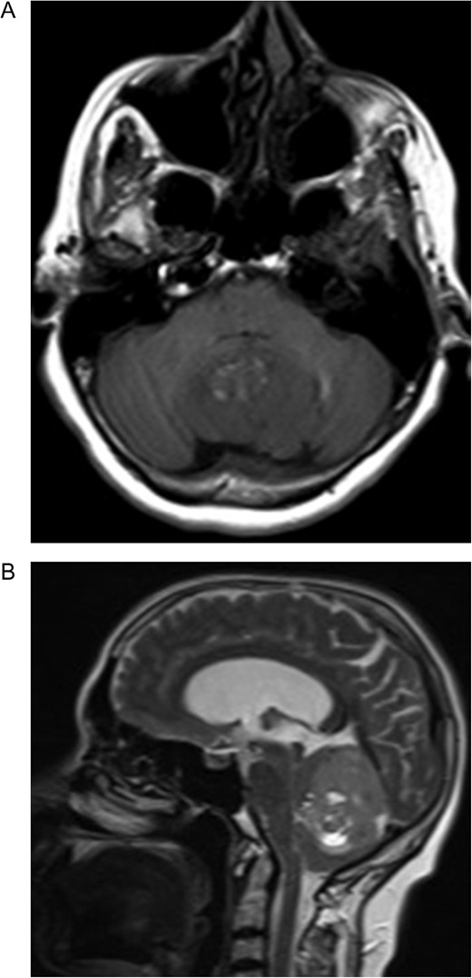 Preoperative MRI (A) Axial T1-weighted MRI showing hypointense lesion located in the cerebellar vermis. Note the hyperintense area corresponding to the fat component. (B) The lesion is hyperintense and well circumscribed on sagittal T2-weighted MRI. Note the supratentorial hydrocephalus secondary to compression of the fourth ventricule.