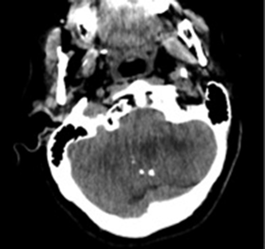 Computed tomography image showing calcifications in the lesion. The margins of the lesion cannot be differentiated from cerebellar parenchyma.