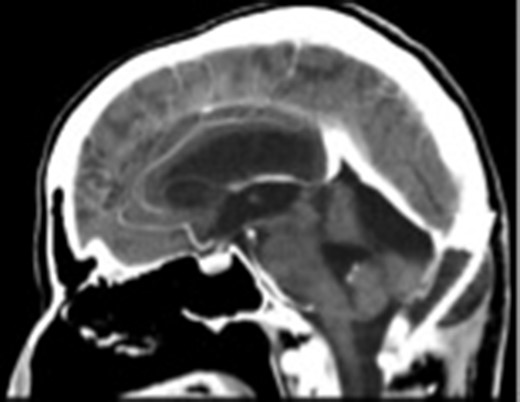 The postoperative sagittal contrast-enhanced CT scan showing that the tumor had been totally excised.