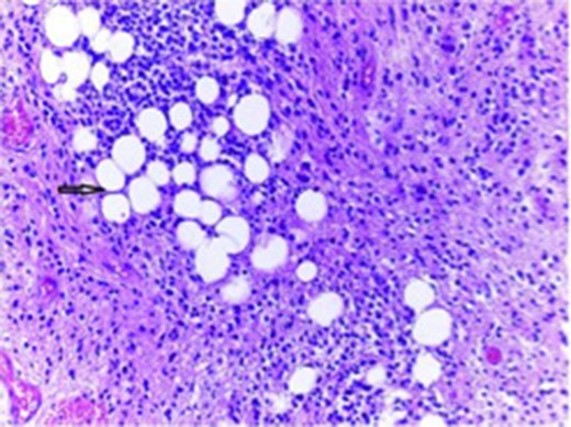 Tumor composed of uniform population of small neurocystic cells arranged in sheets and lobules and with regular round nuclei, clear cytoplasm. The histological hallmark of this entity is the focal accumulation of lipid-laden cells that resemble adipocytes (arrow).