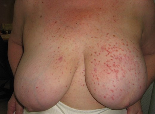 Rash on the left breast, left submammary area and medial right breast, composed of multiple monomorphic erythematous macules.