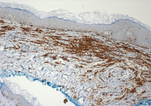 Immunoperoxidase CD117 (c-KIT) stained tissue section of a skin biopsy of the left breast. Mast cell cytoplasmic membrane is stained brown (×10 magnification).