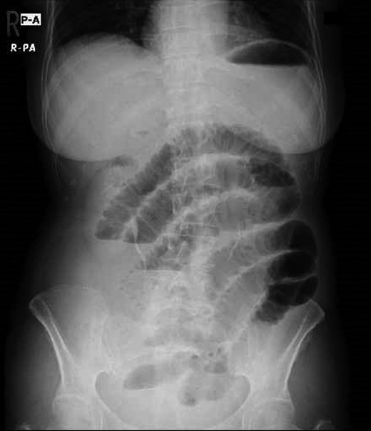 The abdominal X-ray showing distended loops of small bowel.