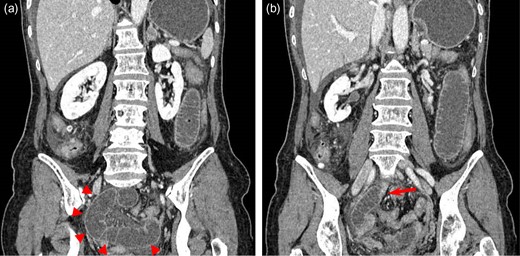 (a) Contrast-enhanced coronal CT image showing a closed loop obstruction located in the pelvis (arrowheads), a slightly decreased bowel wall enhancement of the closed loop, and a moderate volume of ascites. (b) Another coronal slice of CT revealing the change in caliber (arrow) and a whirl sign.