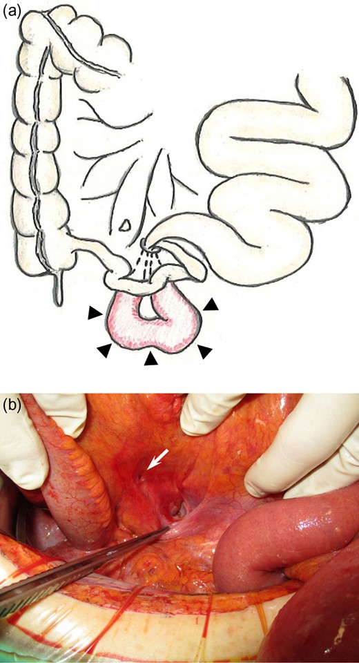 (a) Schema showing strangulated herniation (25 cm long) observed 210 cm from the ligament of Treitz (arrowheads). (b) Intraoperative photograph after reduction. The herniated small bowel had been reduced from the mesenteric defect (2.5 cm), which is pointed to by the forceps. Another defect (1.0 cm, arrow) just distal to the previously identified defect. Both defects had no adhesion around them, and the serous membrane fully covered the marginal lines of the defects.