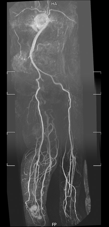 Magnetic resonance angiography of lower limbs. Magnetic resonance angiography showed a normal peripheral arterial supply to both lower limbs.