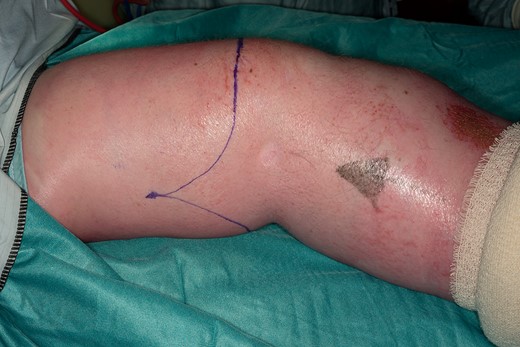 Right knee. Right knee marked with fish mouth incision in preparation for above knee amputation.
