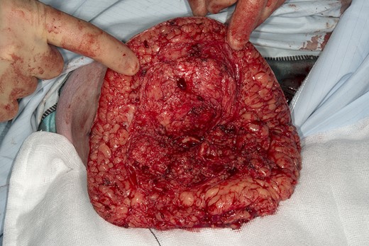 Right above knee amputation. Right above knee amputation through fish mouth incision.