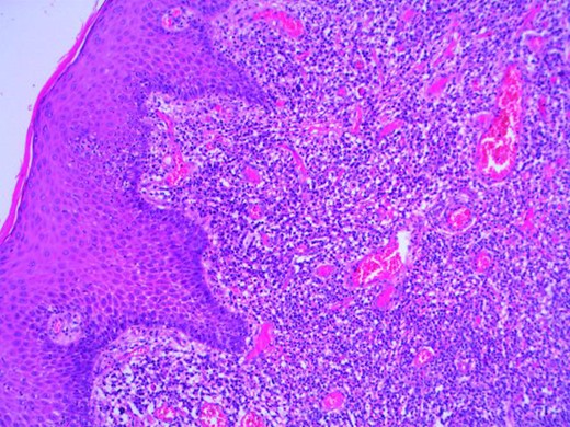 Microscopy photograph from the histological specimen; perianal skin tissue with localized plasma cell rich inflammation.