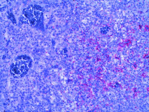 Microscopy photograph from the histological specimen; positive immune-stain for spirochaetes (seen in pink).