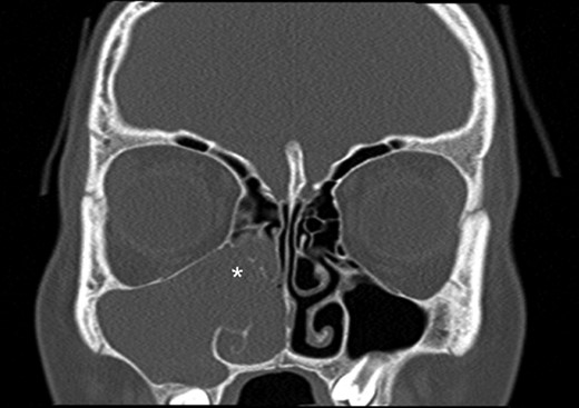 Coronal computed tomography (bone window) image showing a right-sided antrochoanal mass (white asterisk) extending in to the maxillary and ethmoidal sinuses.