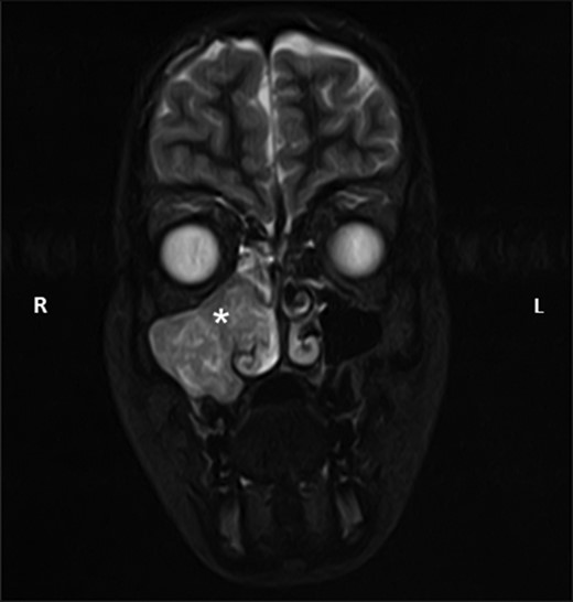 Coronal STIR sequence magnetic resonance image taken as part of the diagnostic investigations, showing the same antrochoanal mass (white asterisk) showing extension into the nasal cavity. L, left; R, right.