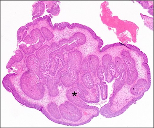 Medium power photomicrograph showing benign proliferative papillomatous type lesion with oedematous stroma and inflammation. There is invagination of the epithelium into the stroma (black asterisk) (H&E; ×20).