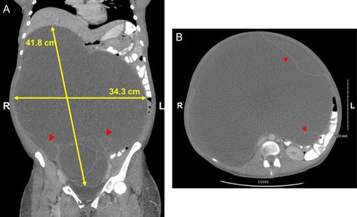 Coronal (A) and axial (B) views highlighting size of GOMC, displacement of abdominal organs and cystic loculations (arrowheads).