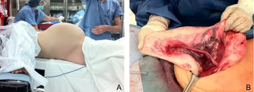 Patient supine prior to percutaneous drainage (A) and whitish cyst wall after drainage (B).