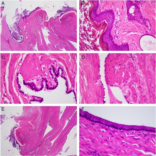 (A) Low power (20×) of mature cystic teratoma lined by ectodermal squamous epithelium (arrowhead), cutaneous appendages, and endodermal glandular/gastrointestinal epithelium. (B) High power (400×) mature cystic teratoma lined by ectodermal squamous epithelium cutaneous appendage (arrowhead). (C) High power (600×) ciliated endodermal respiratory epithelium (arrowhead). (D) High power (600×) endodermal smooth muscle (arrowhead). (E) Low power (20×) mucinous cystic teratoma with adjacent mucinous cystadenoma (arrowhead). (F) High power (400×) mucinous cystadenoma.