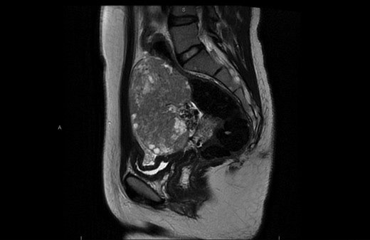 CT scan showing large right sided heterogeneous lesion 10 × 10 × 7 cm3.